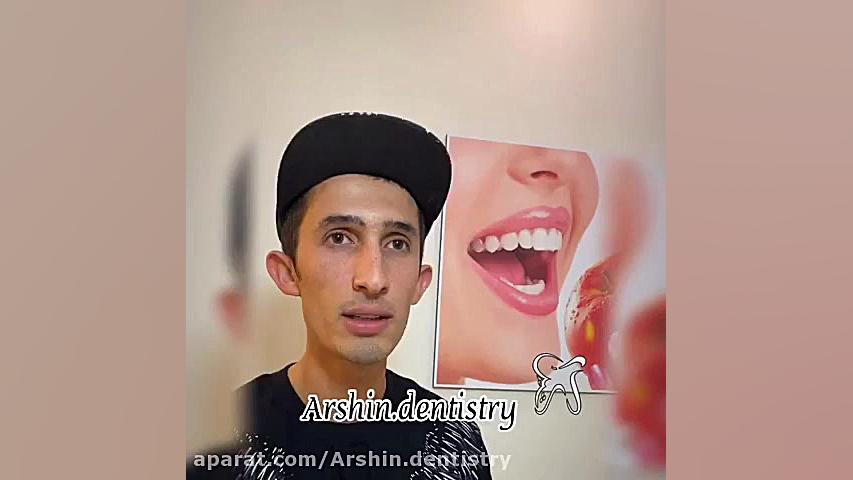 اصلاح لبخند لثه ای بدون جراحی و اجرای ده واحد کامپوزیت پزشکی کوهستان
