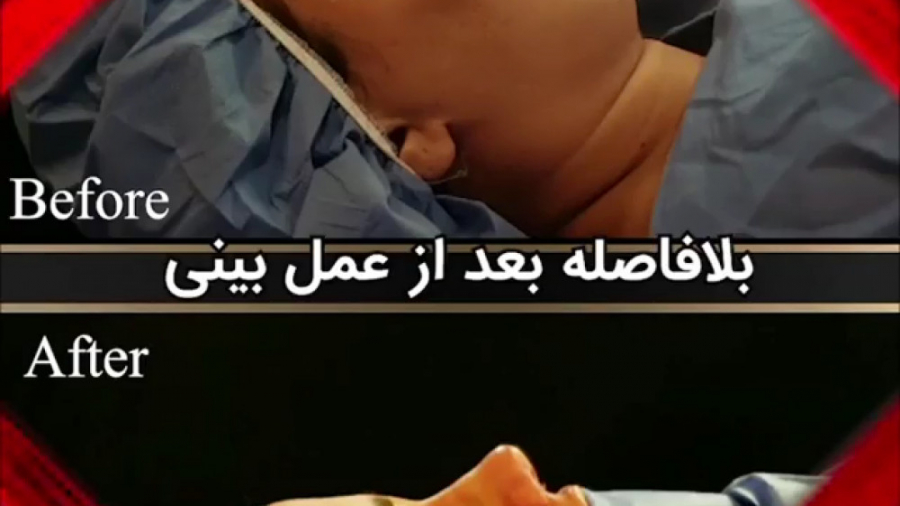 بلافاصله بعد از عمل بینی، توسط دکتر امید ابراهیمی بهترین جراح بینی در تهران دکتر امید ابراهیمی