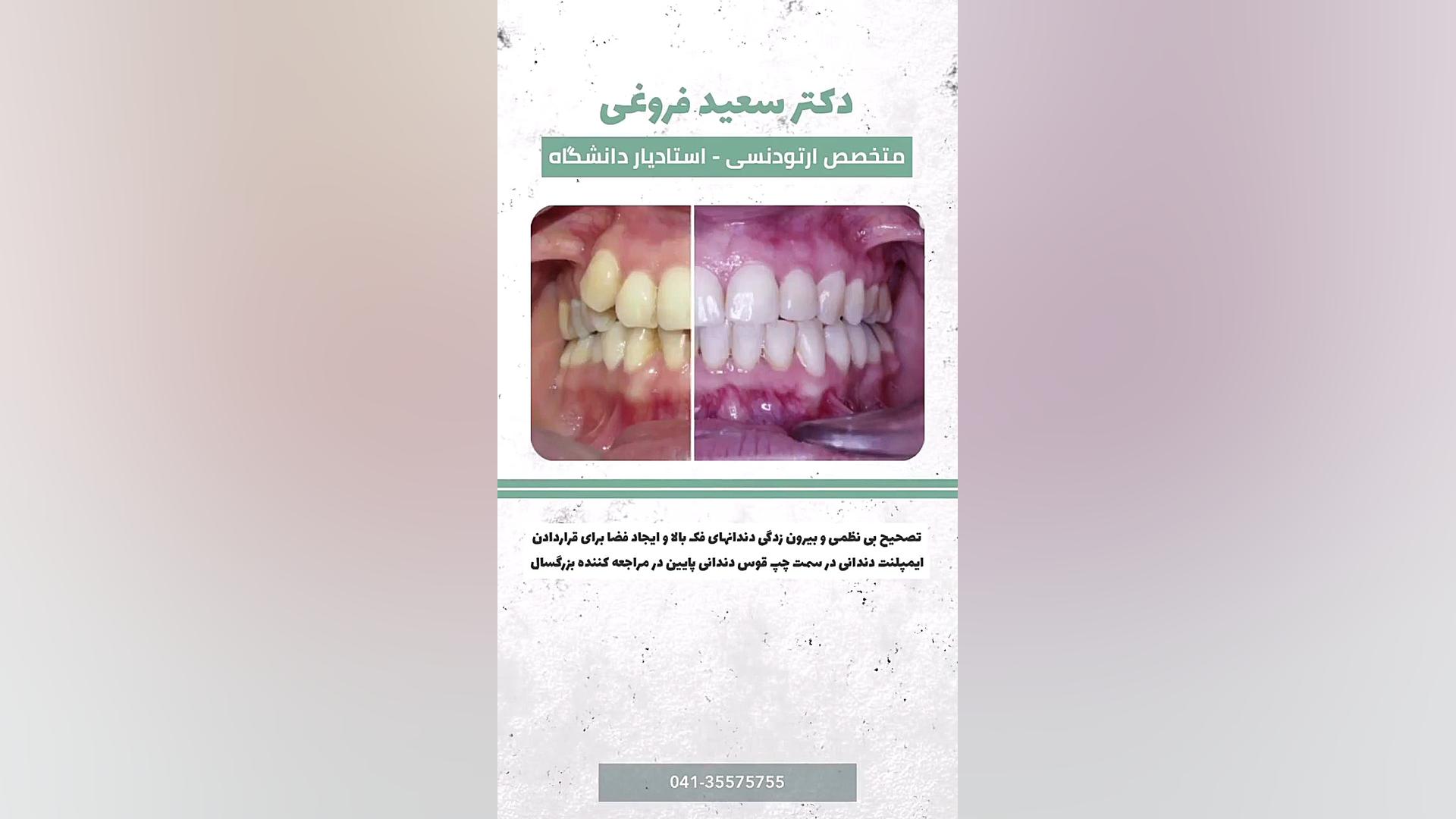 تصحیح بی نظمی و بیرون زدگی دندان های فک بالا دکتر سعید فروغی متخصص ارتودنسی