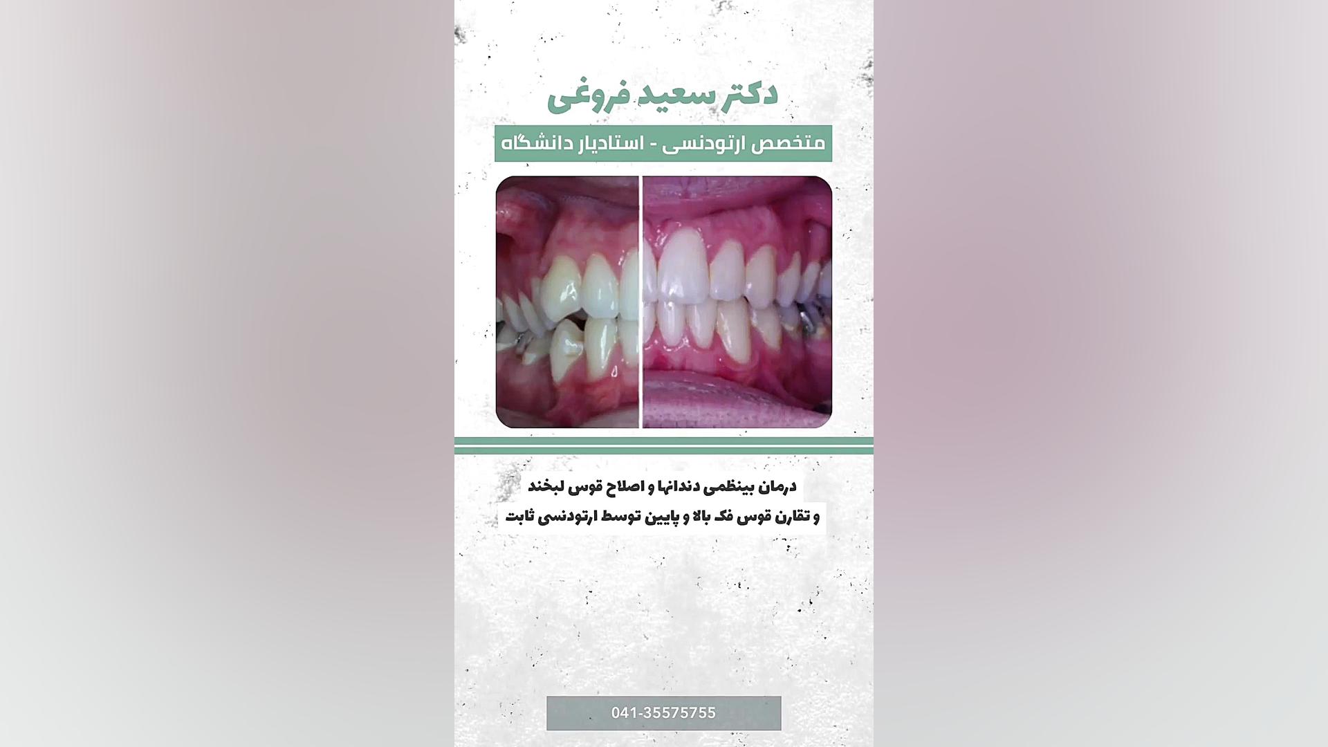 تصحیح بی نظمی دندان ها و اصلاح قوس لبخند توسط ارتودنسی ثابت دکتر سعید فروغی متخصص ارتودنسی