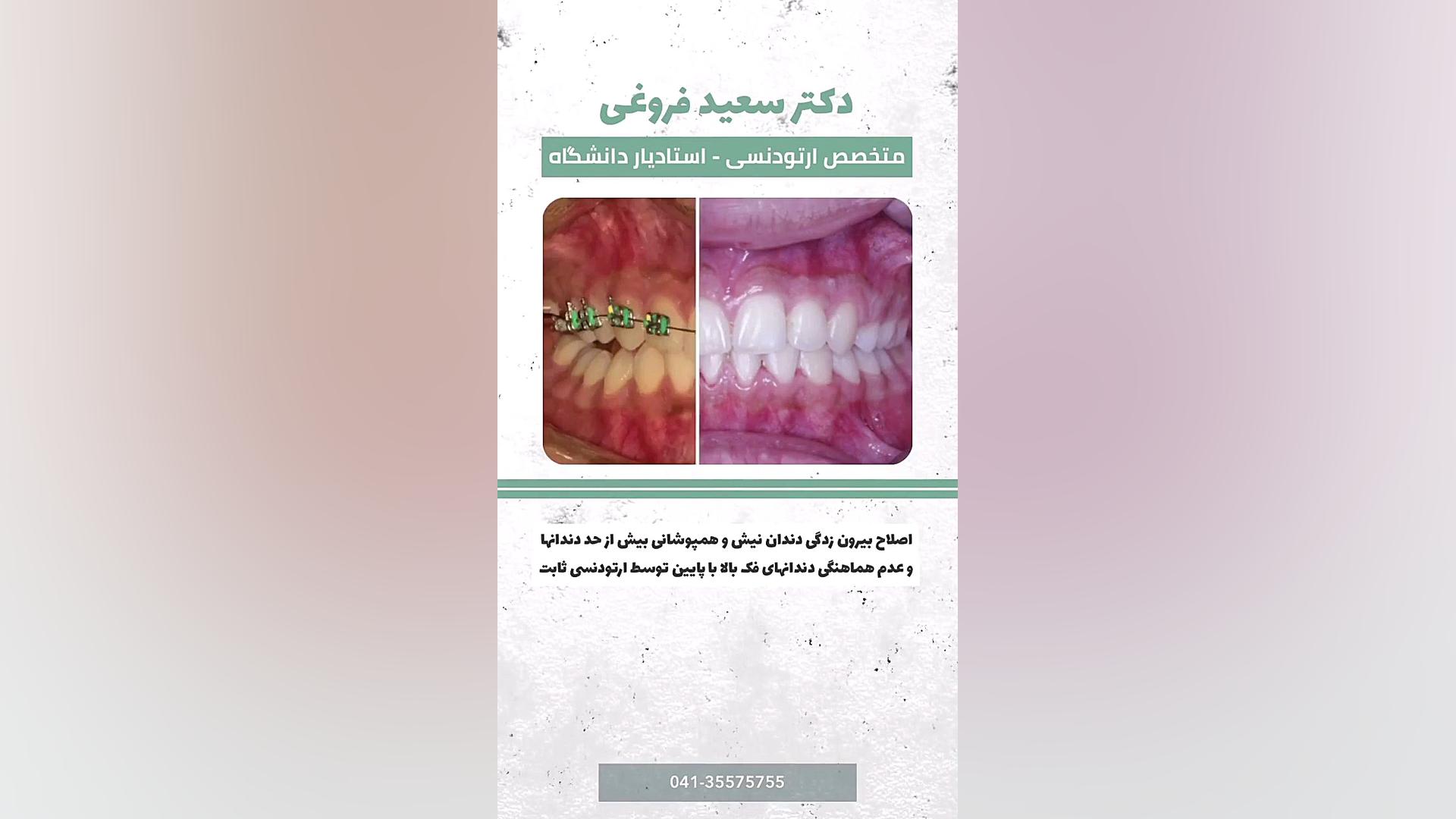 ارتودنسی ثابت دکتر سعید فروغی متخصص ارتودنسی