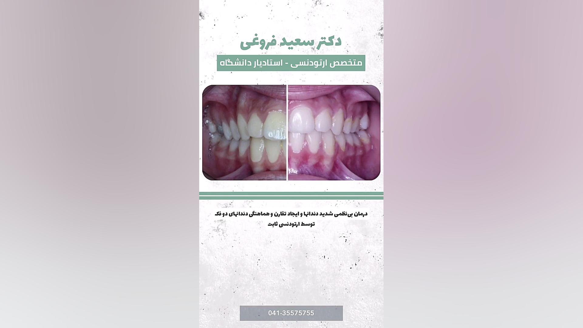 ارتودنسی ثابت دکتر سعید فروغی متخصص ارتودنسی