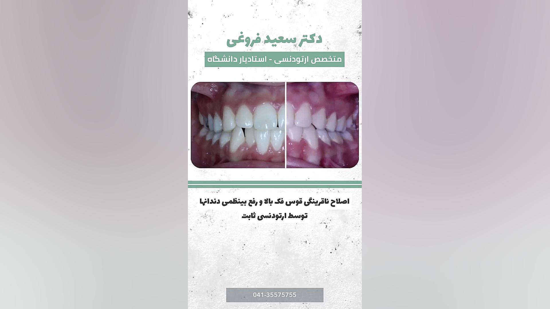 ارتودنسی ثابت دکتر سعید فروغی متخصص ارتودنسی