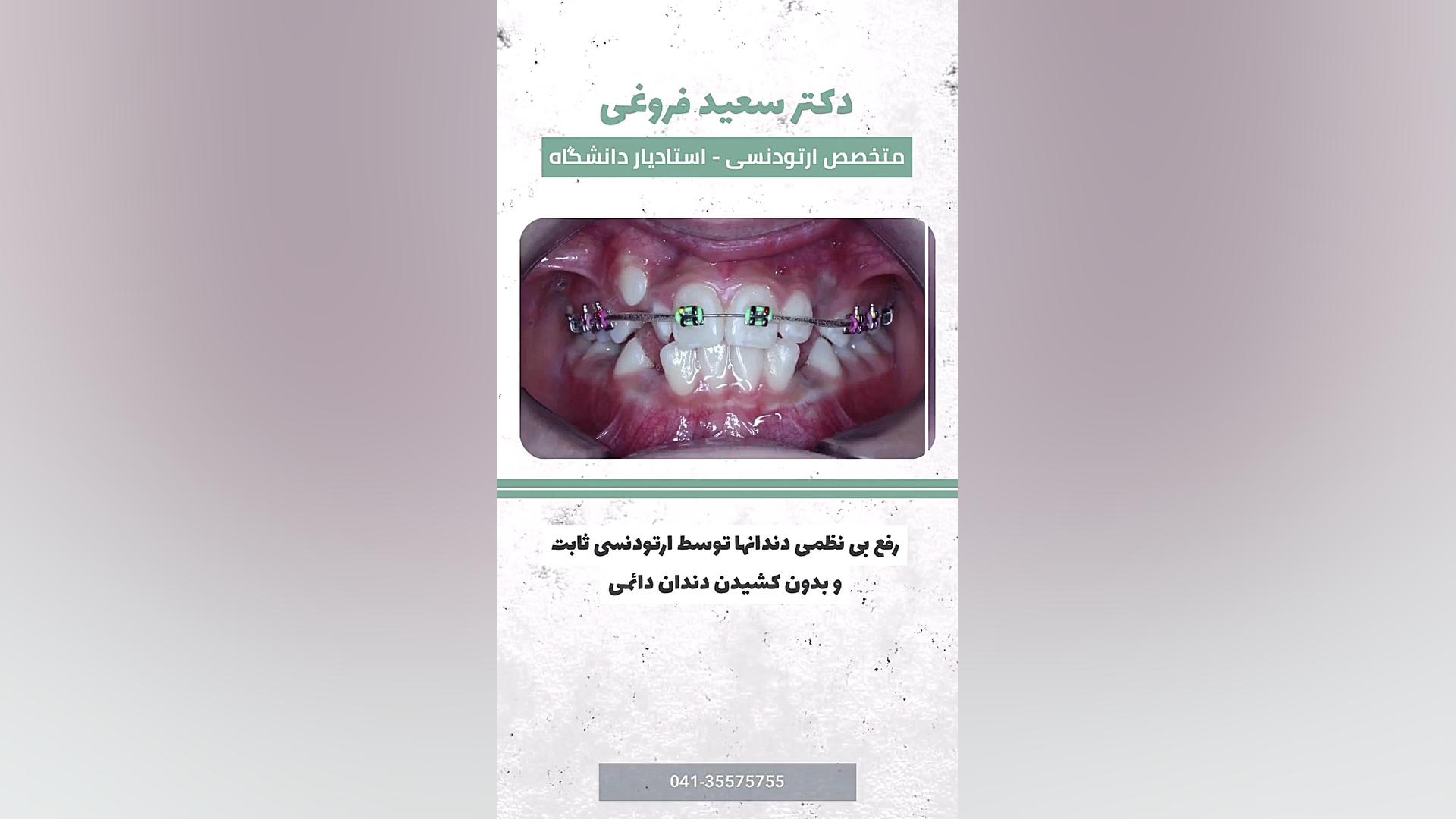 ارتودنسی ثابت دکتر سعید فروغی متخصص ارتودنسی