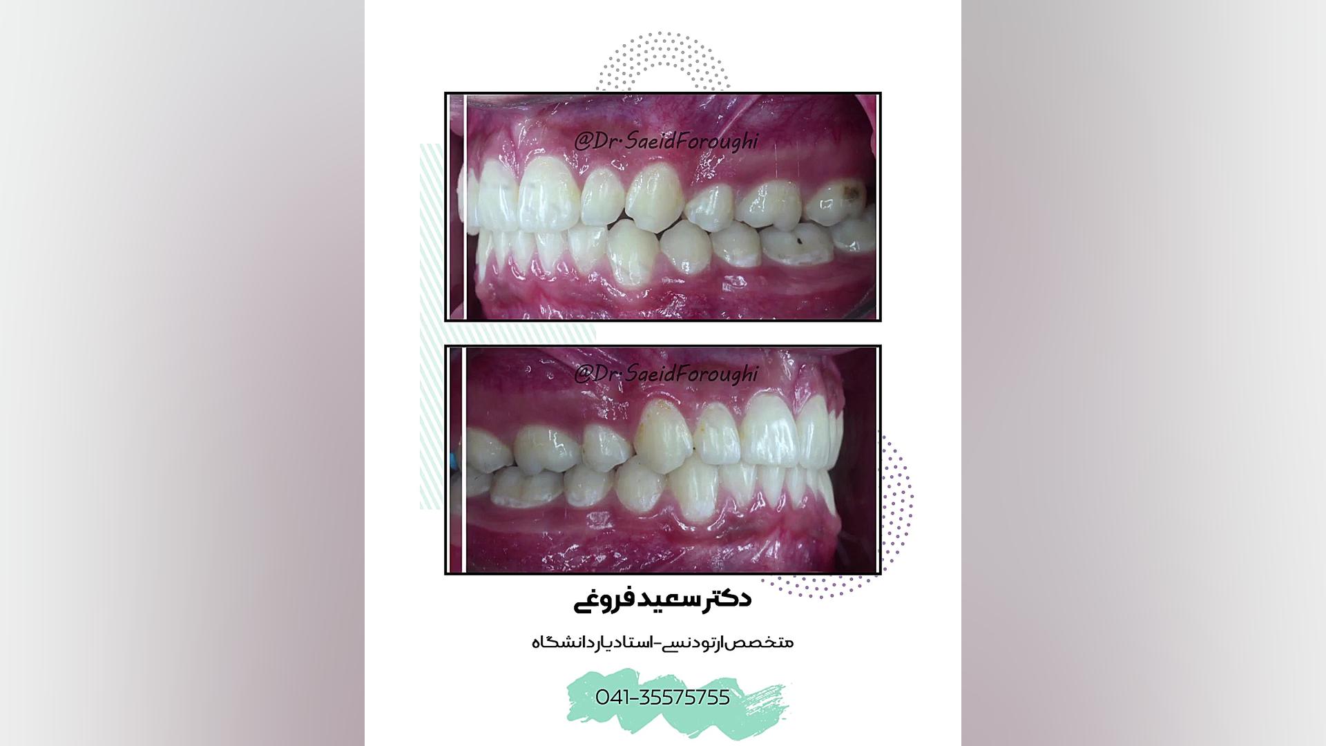 درمان بینظمی و بیرون زدگی دندانها و اصلاح طرح لبخند توسط ارتودنسی ثابت دکتر سعید فروغی متخصص ارتودنسی