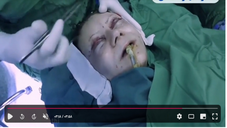 فیلم عمل جراحی لیفت صورت دکتر حمید رضا فتحی فوق تخصص جراحی پلاستیک
