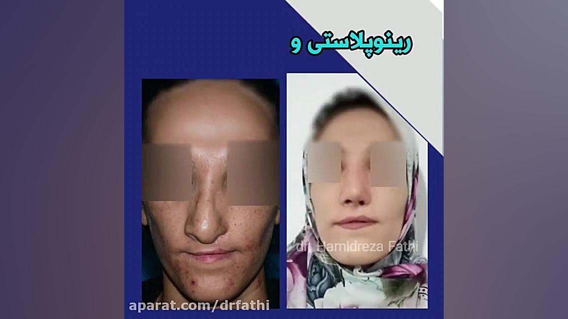 شکاف کام و لب در بزرگسالی و جراحی بینی دکتر حمید رضا فتحی فوق تخصص جراحی پلاستیک