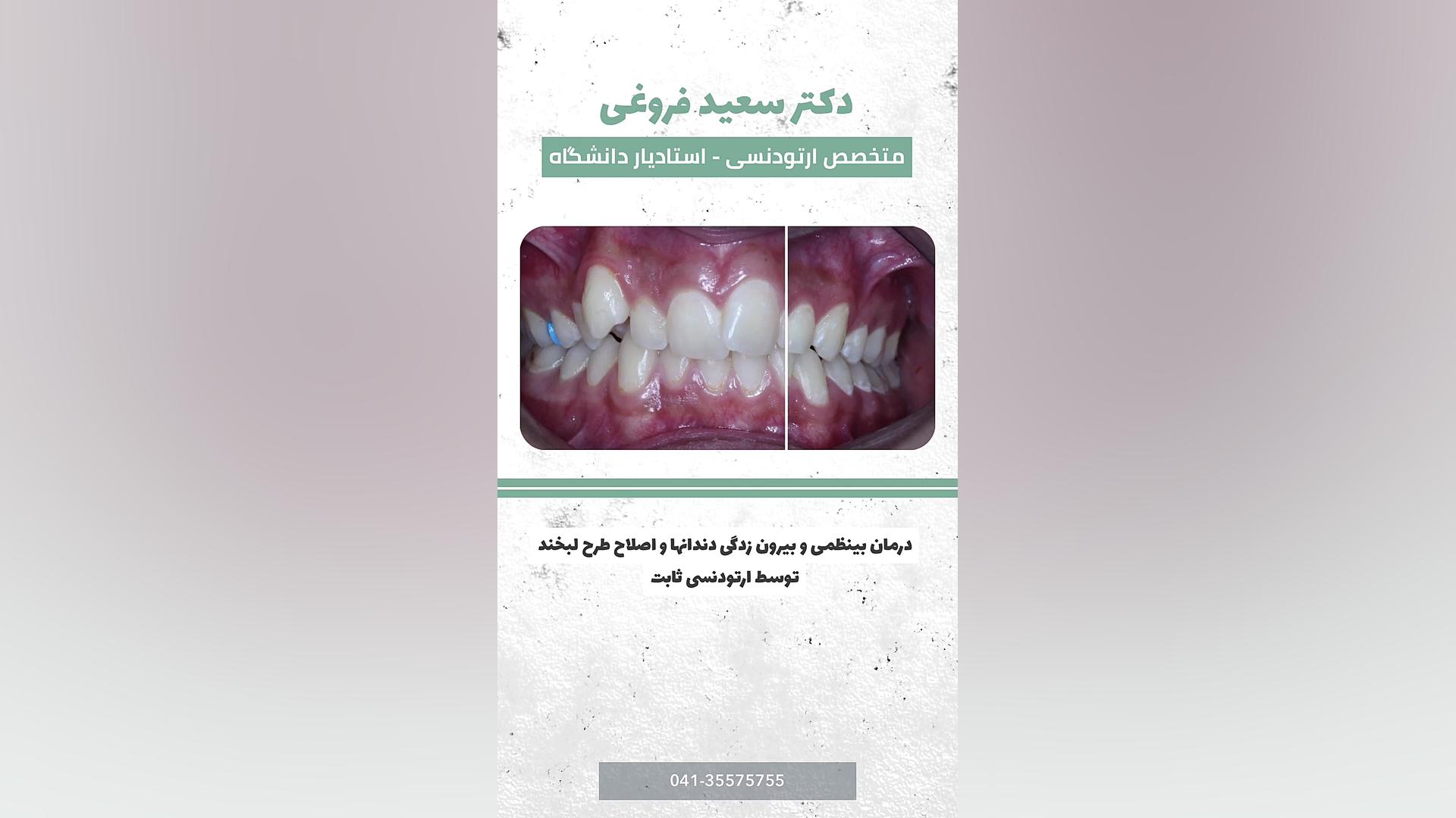 درمان بینظمی و بیرون زدگی دندانها و اصلاح طرح لبخند توسط ارتودنسی ثابت دکتر سعید فروغی متخصص ارتودنسی
