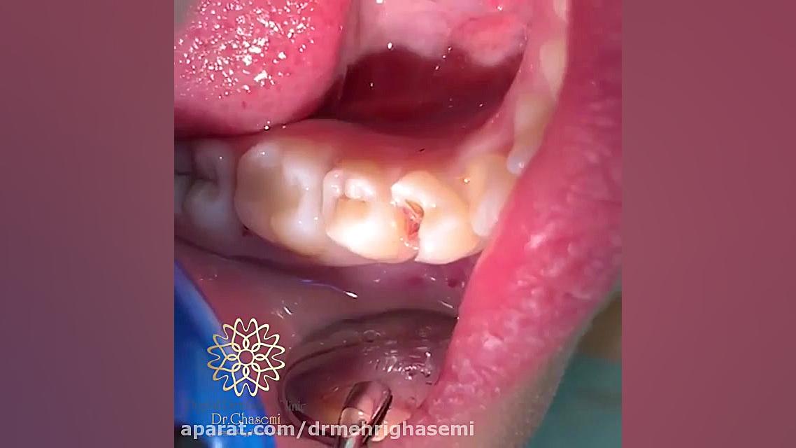 برداشتن پوسیدگی ها با استفاده از لیزر | کلینیک دندانپزشکی دیجیتال دکتر قاسمی مرکز دندانپزشکی دیجیتال دکتر مهری قاسمی