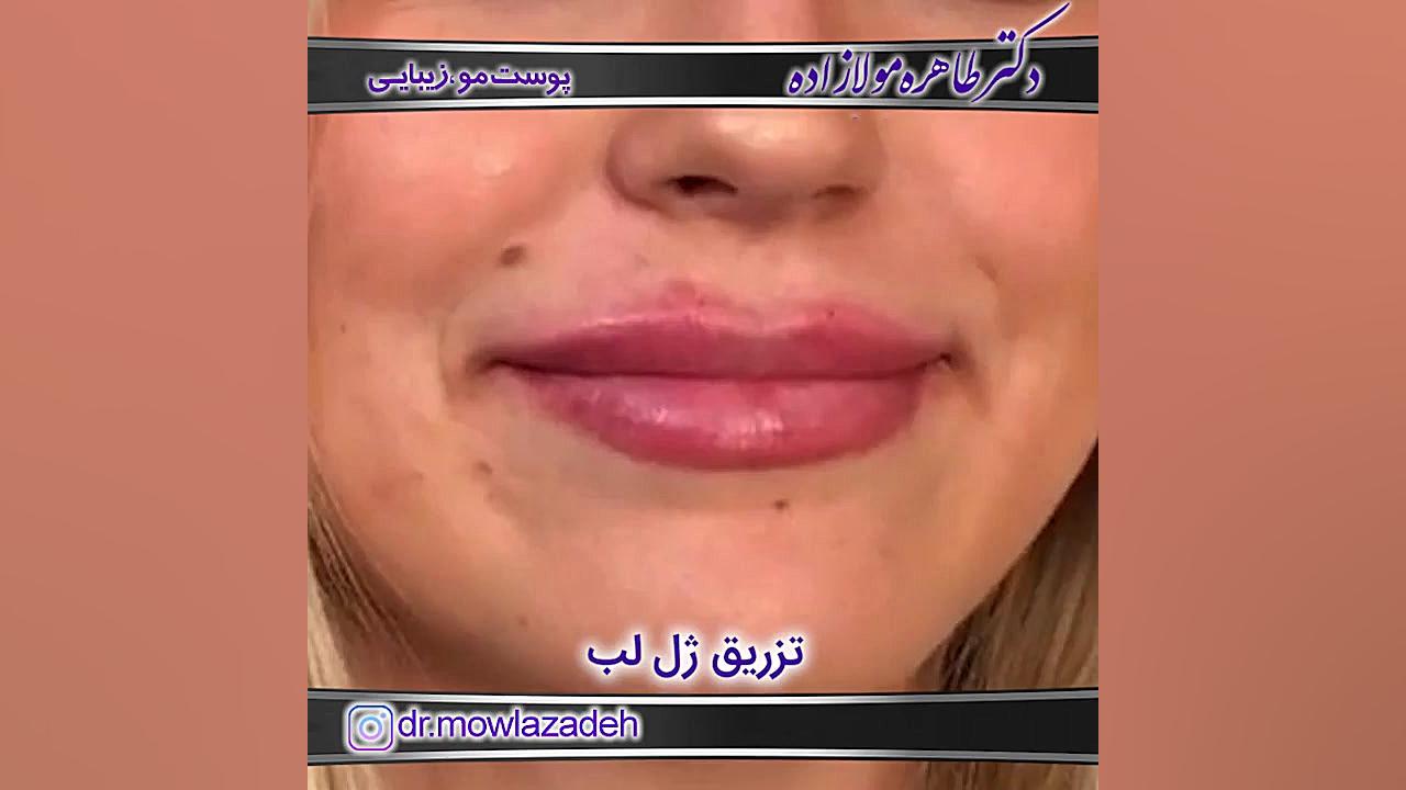فیلم تزریق ژل لب انسریدا