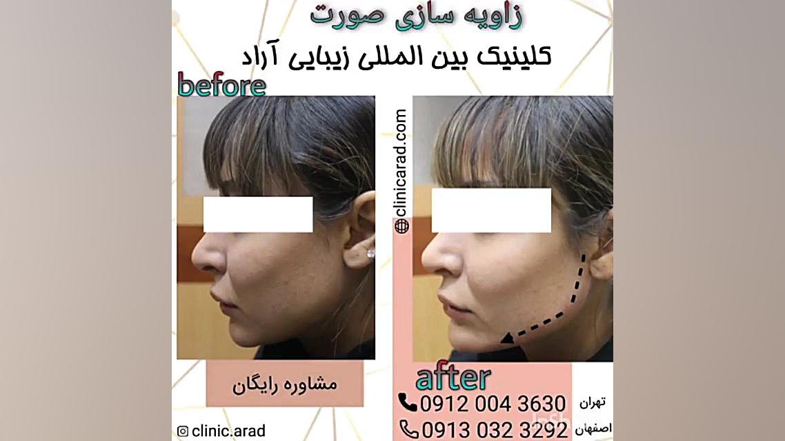 زاویه سازی صورت جراحی فک