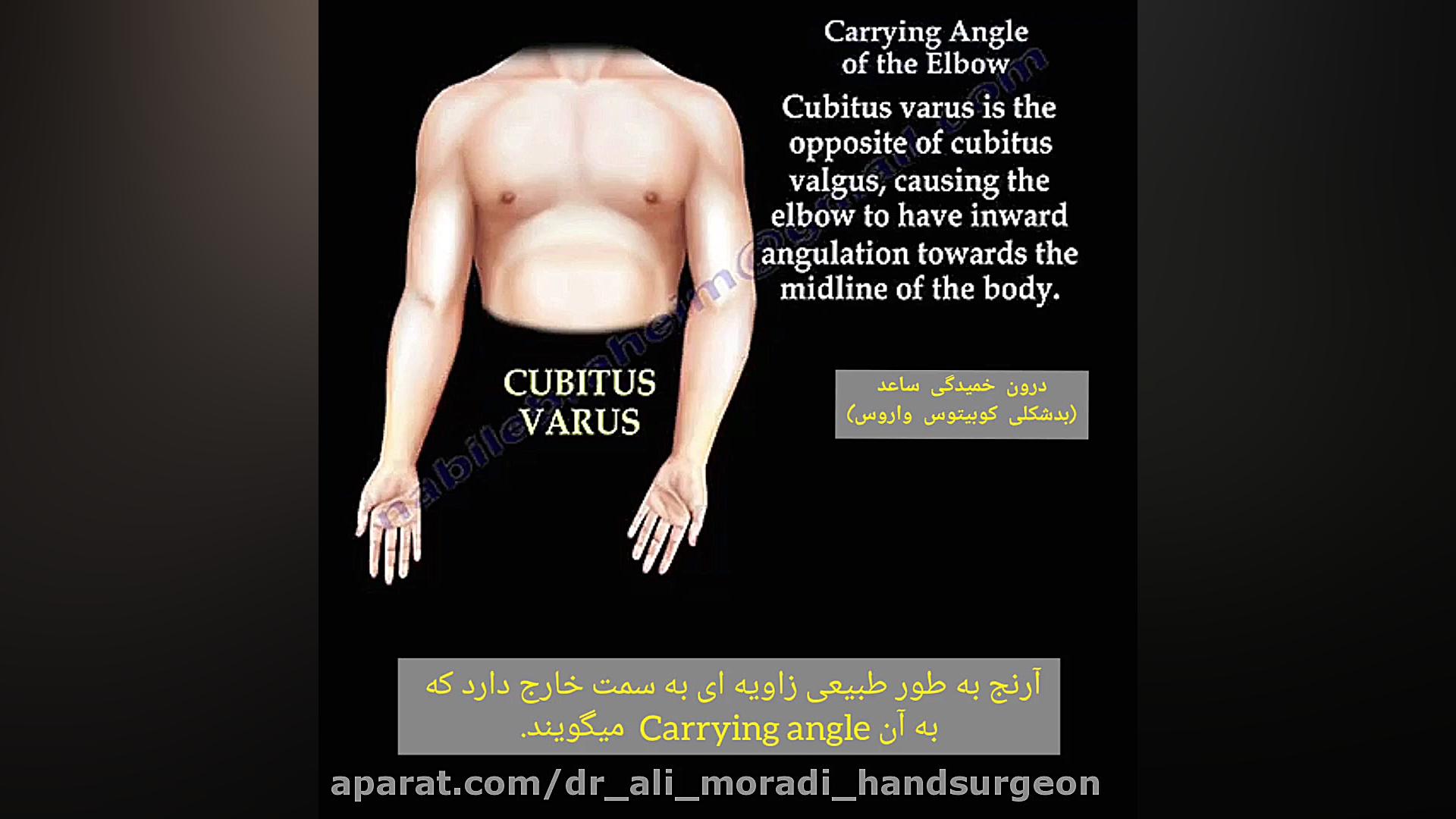 بیماری کوبیتوس واروس- Cubitus Varus دکتر علی مرادی جراح دست