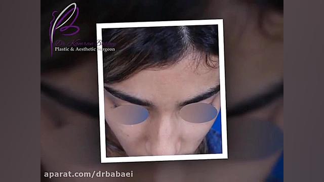 فیلم بلافاصله بعد از عمل بینی گوشتی دکتر کامران بابایی