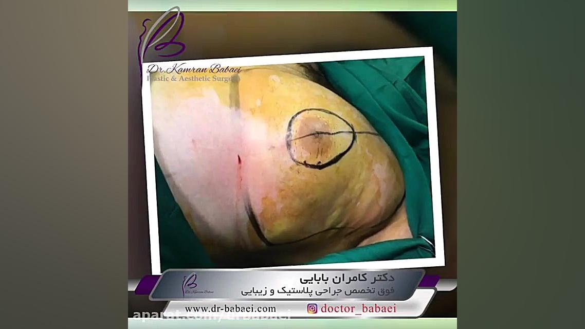 فیلم واقعی بلافاصله بعد از ژنیکوماستی دکتر کامران بابایی