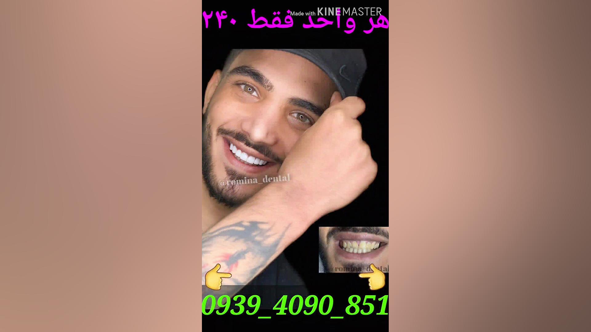 کامپوزیت ونیر تخفیف ویژه /لمینیت/دندان/دندانپزشکی/بلیچینگ/زیبایی/تهران/ پمپ انسولین ایمپلنتی
