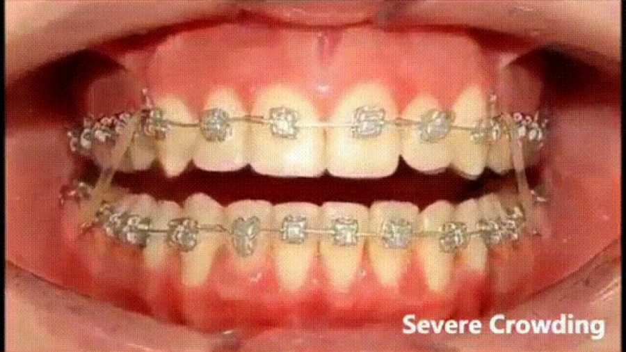 مراحل درمان ارتودنسی / متخصص ارتودنسی / دکتر جمیلیان دکتر عبدالرضا جمیلیان - متخصص ارتودنسی