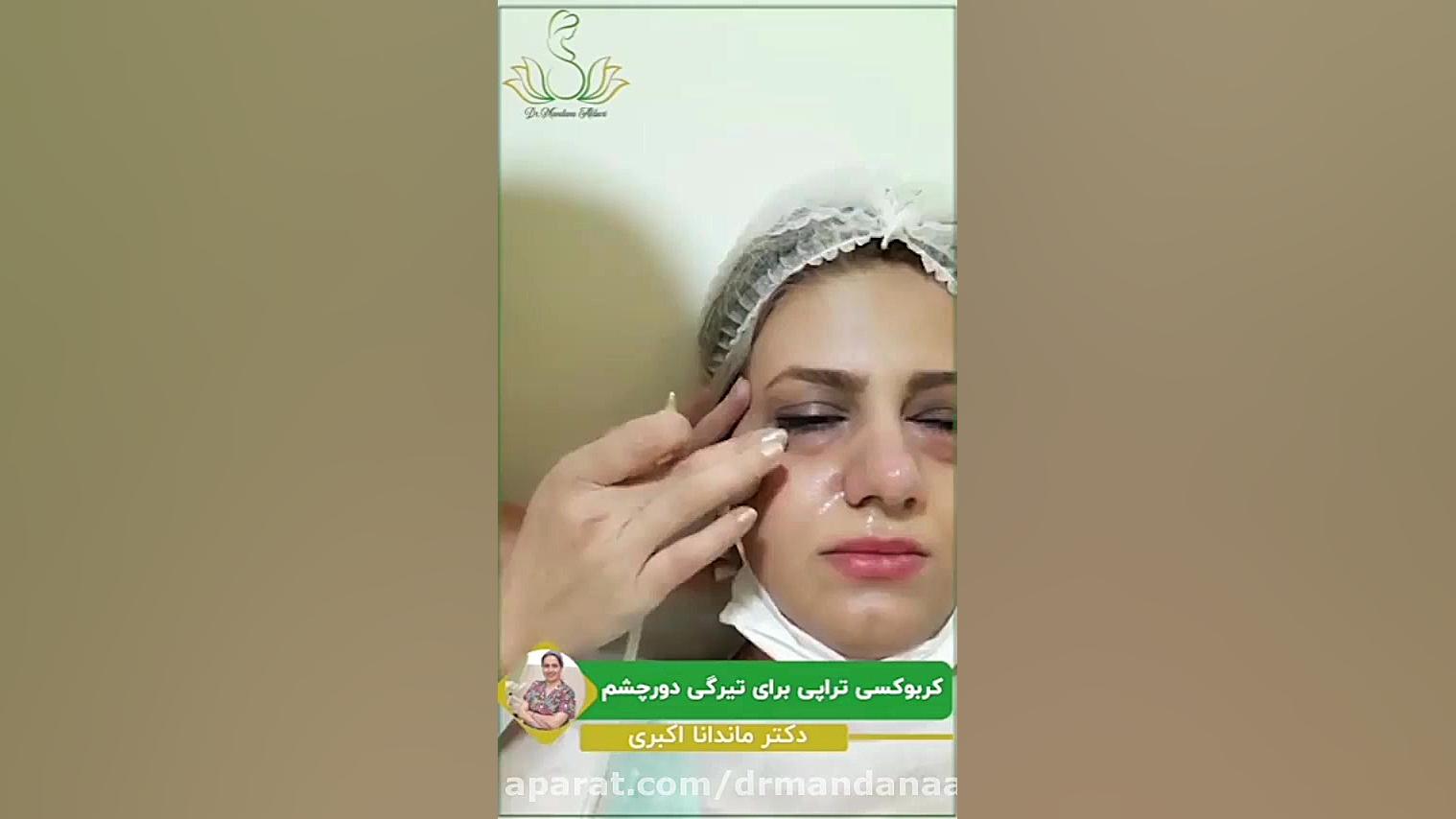 کربوکسی تراپی برای رفع تیرگی چشم دستگاه آنالیز ایمیجینگ سلول زنده