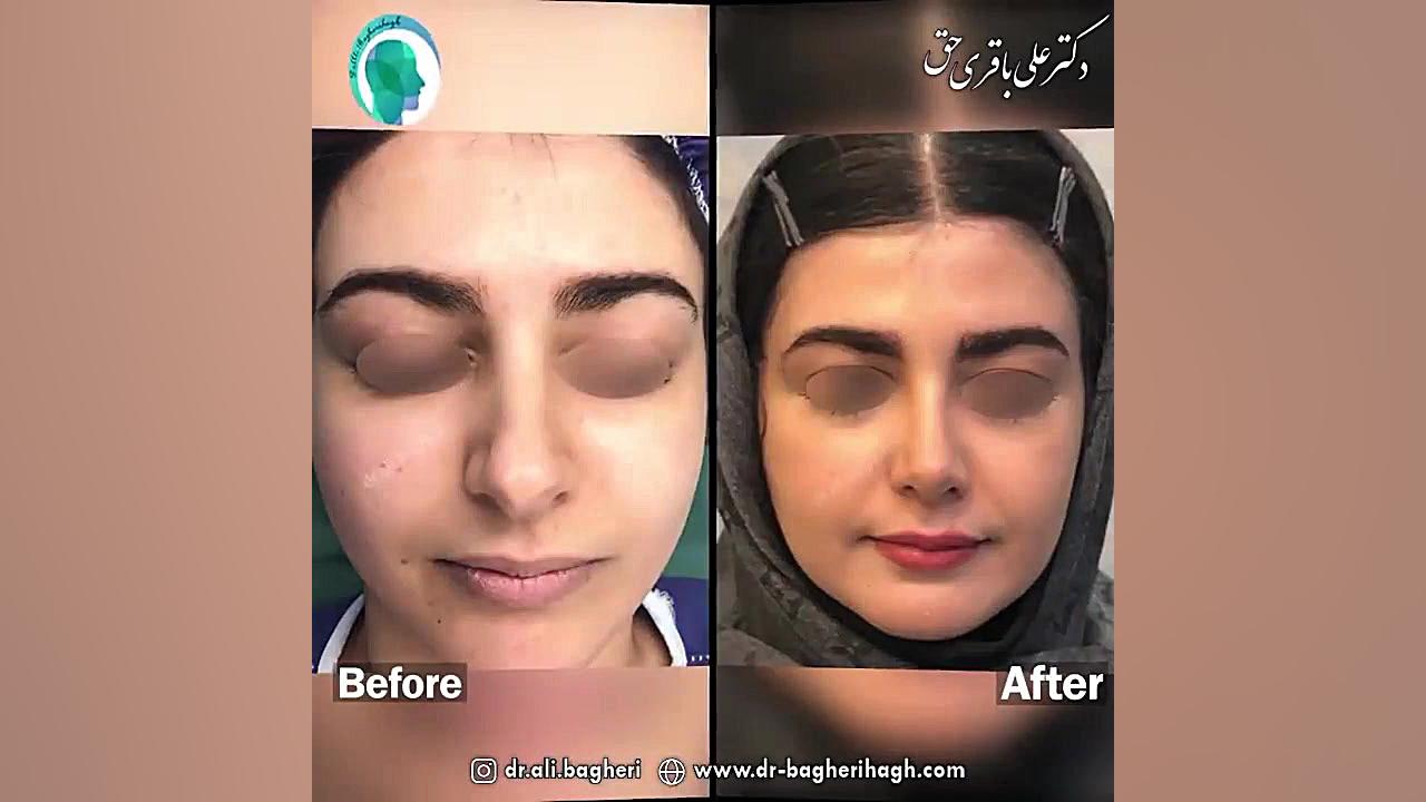 قبل و بعد جراحی بینی دکتر علی باقری حق