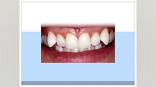 ارتودنسی دندان نیش دکتر سهیل سالاری