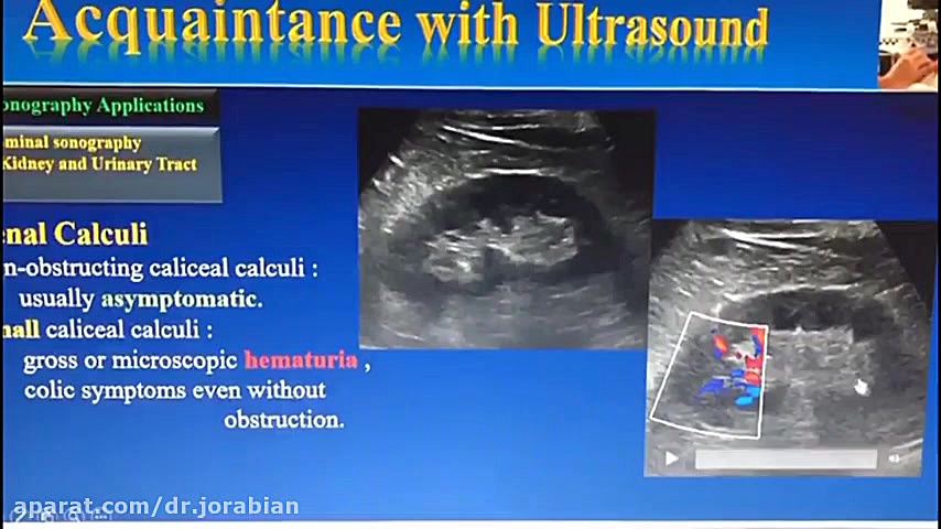 چالش های تشخیص سنگ کلیه در سونوگرافی و فیلم مربوط به آن جراحی بینی