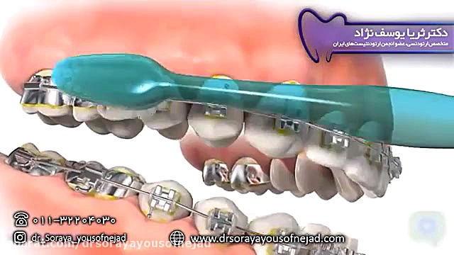 نحوه صحیح مسواک زدن با براکت ارتودنسی دکتر ثریا یوسف نژاد متخصص ارتودنسی بابل