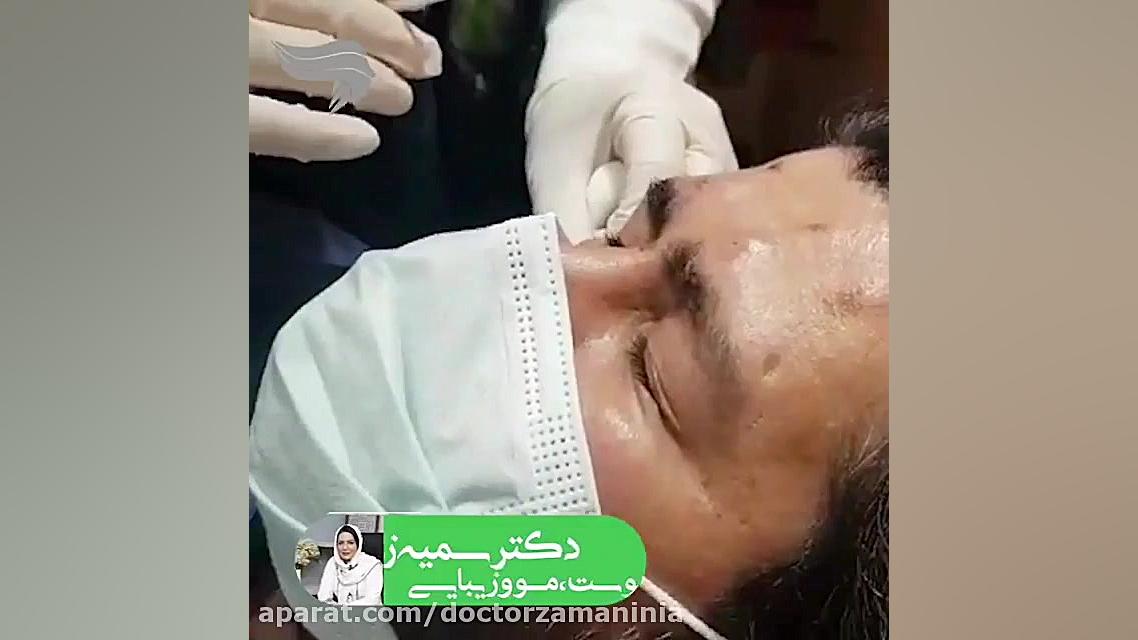 تزریق بوتاکس در پیشانی و دور چشم آتپازیب