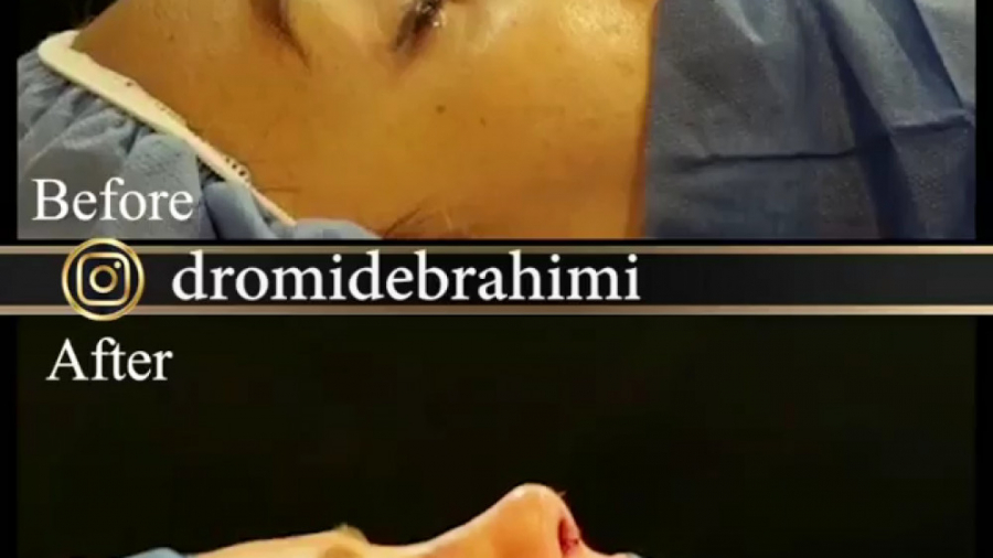 بلافاصله بعد از عمل بینی توسط دکتر امید ابراهیمی بهترین جراح بینی در تهران دکتر امید ابراهیمی