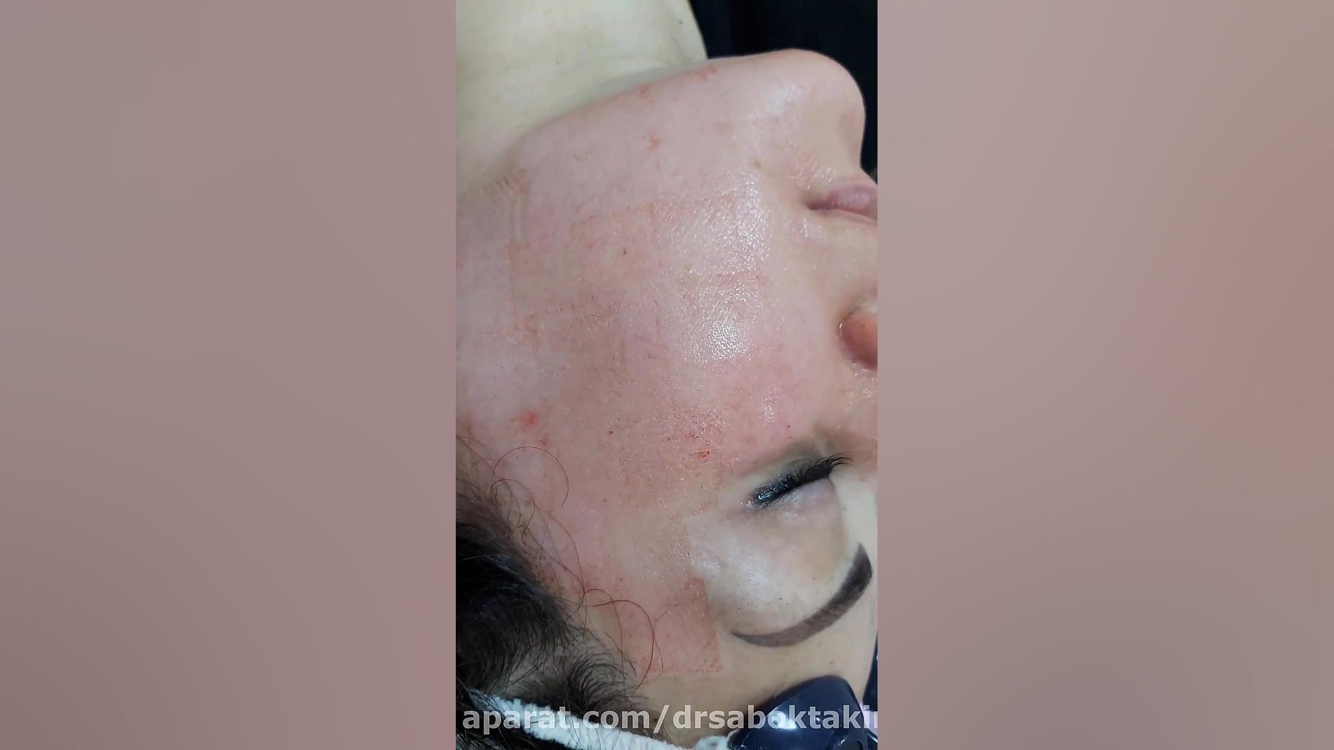 لیزر فرکشنال جهت درمان کک، مک و لک ها/ توسط دکتر مهدی سبکتکین متخصص پوست اصفهان متخصص پوست اصفهان دکتر مهدی سبکتکین