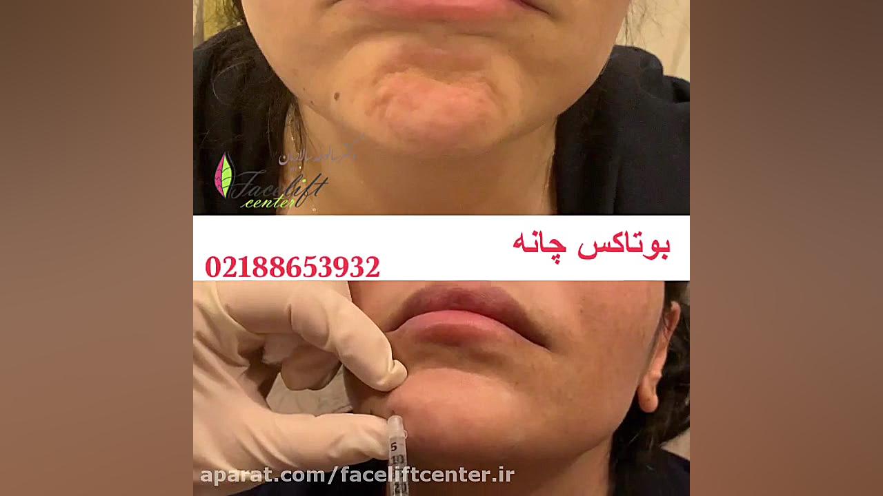 تزریق بوتاکس چانه بیماری پیرفیریک نوروپاتی