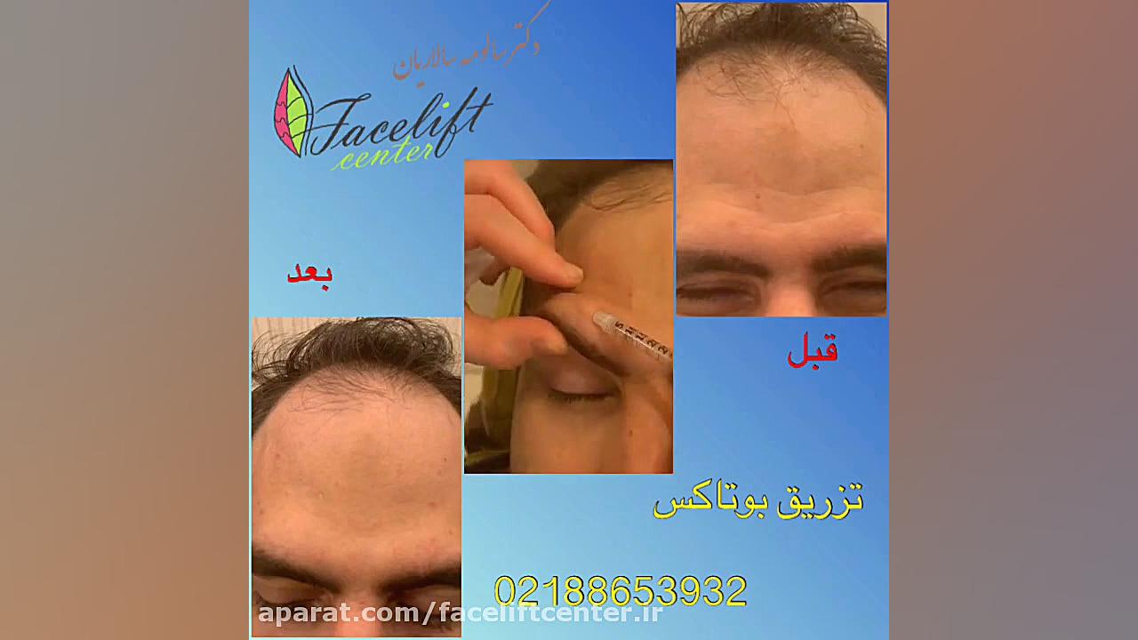 قبل و بعد از تزریق بوتاکس پیشانی لکوپنی شدید