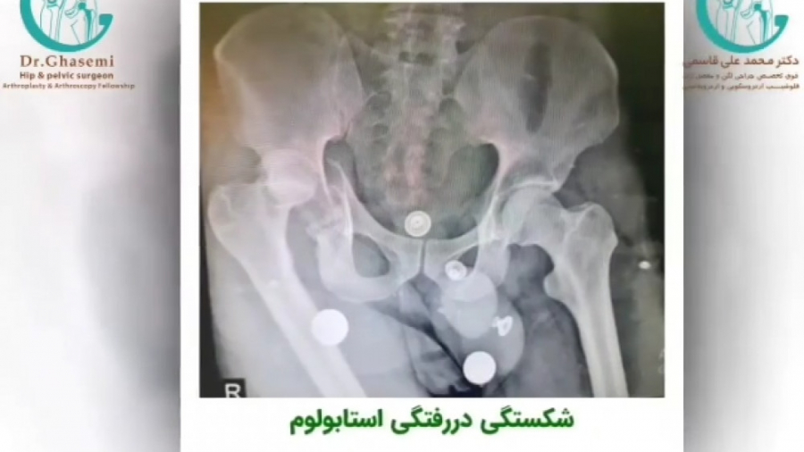 درمان شکستگی پیچیده لگن سحر قریشی
