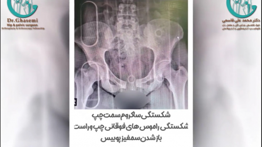 شکستگی پیچیده لگن از سه ناحیه مزوتراپی