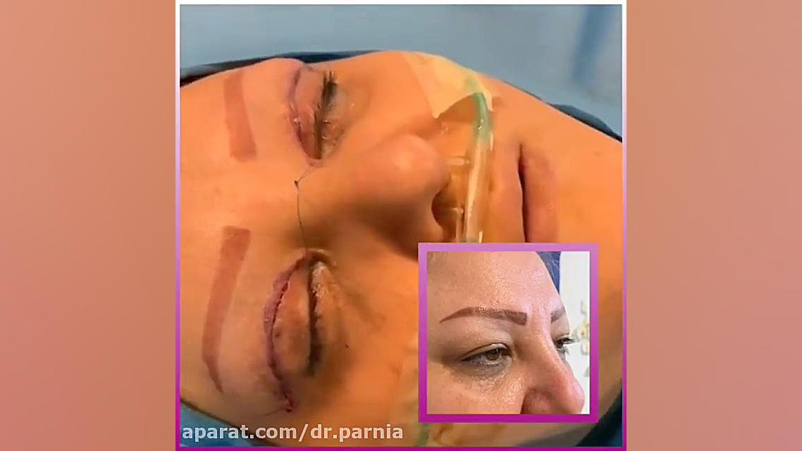 جراحی پلک بدون بیهوشی دکتر رفیع پرنیا فوق تخصص پلاستیک