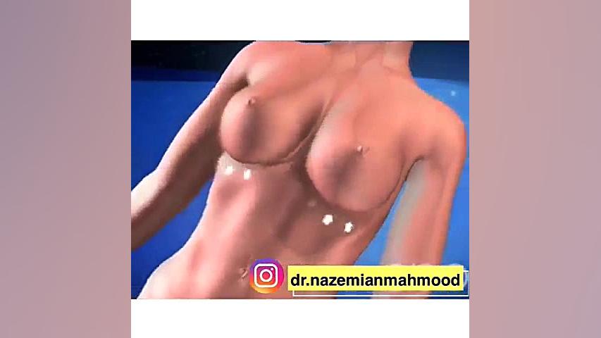 جراحی پروتز سینه پالبوسیکلیب