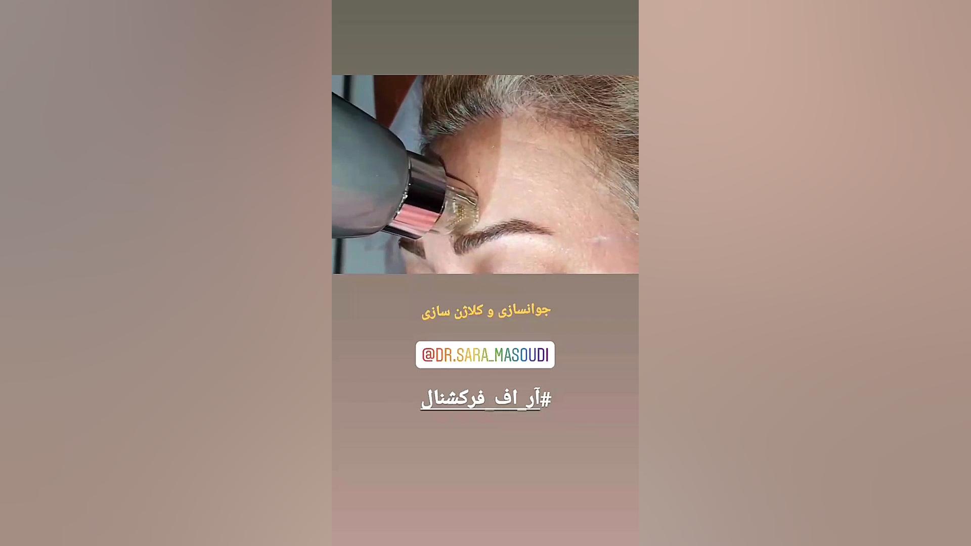 آر اف فرکشنال کاشان V/Q Scan