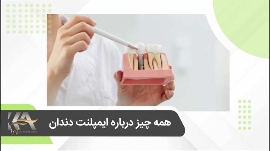 همه چیز درباره ایمپلنت دندان دکتر کامیار عباسی دکتر کامیار عباسی