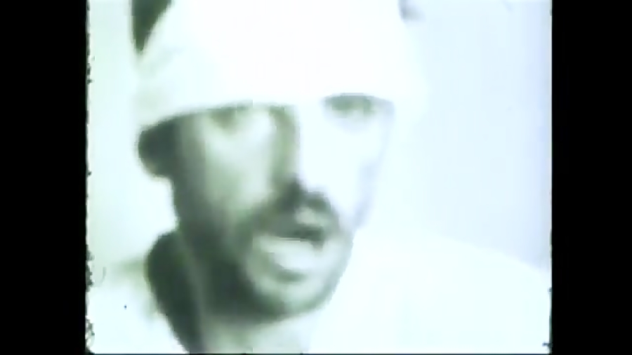 بیماری هاری در انسان مایکروگناتیا