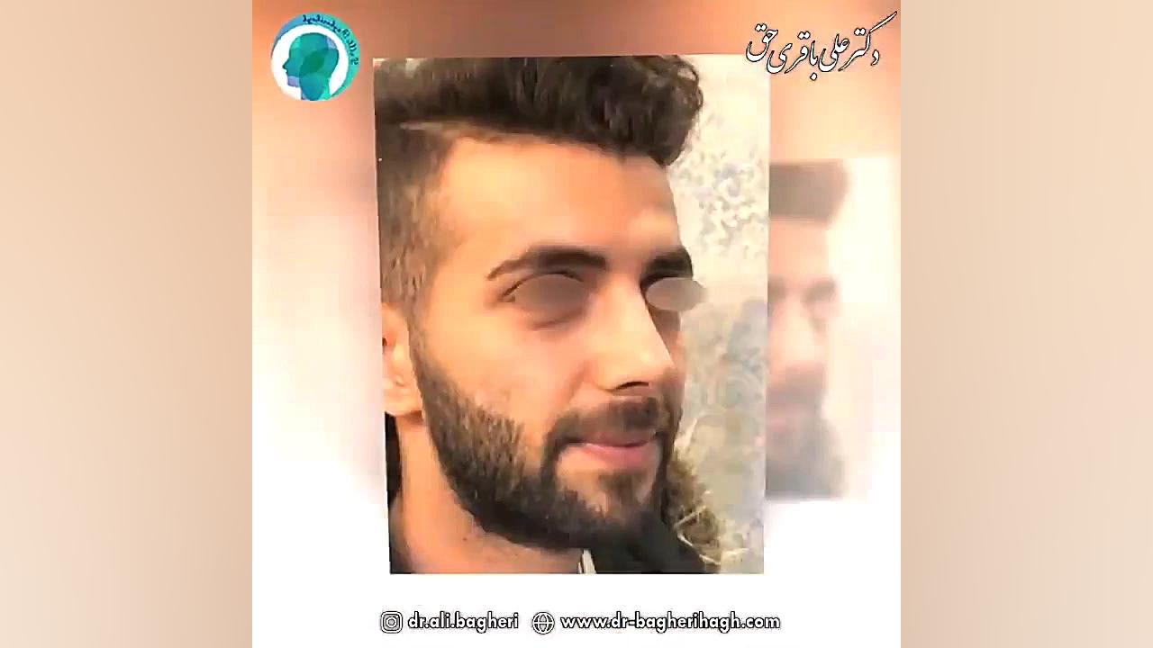 جراحی بینی توسط دکتر باقری حق دکتر علی باقری حق