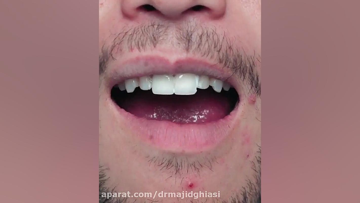 ونیر دندانی دکترمجیدقیاسی