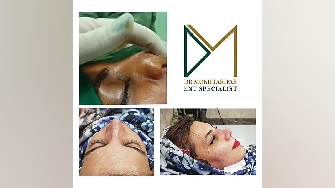 سه هفته پس از جراحی بینی به شدت گوشتی با غضروفهای ضعیف داشتن دکتر فاطمه مختاری فر جراح بینی در لرستان