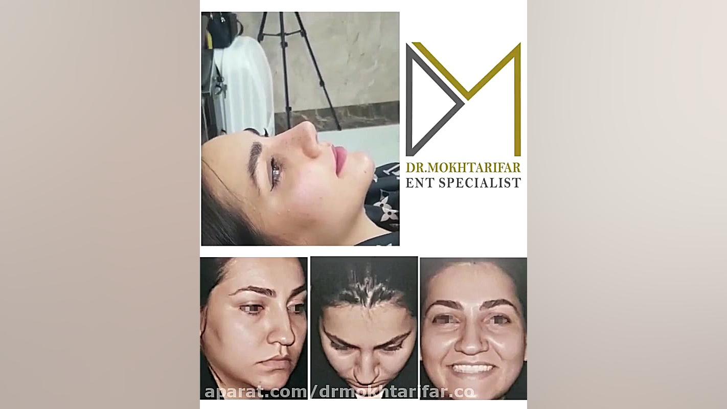 حدود سه هفته پس از جراحی زیبایی بینی گوشتی دکتر فاطمه مختاری فر جراح بینی در لرستان