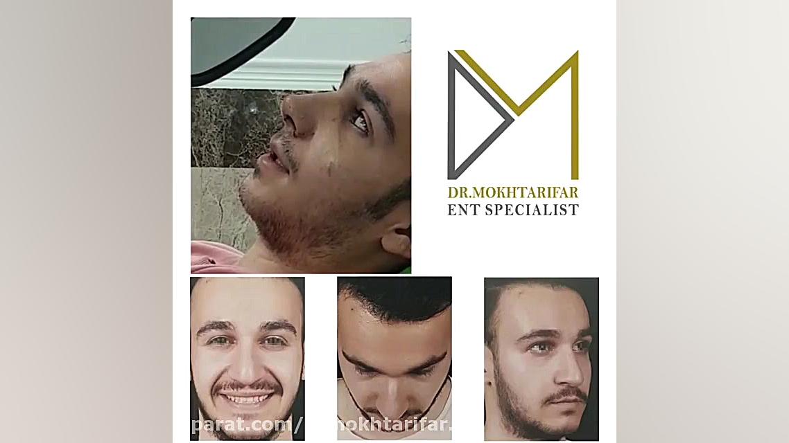 جراحی زیبایی بینی به فرم طبیعی بلافاصله پس از برداشتن اسپلینت بینی دکتر فاطمه مختاری فر جراح بینی در لرستان