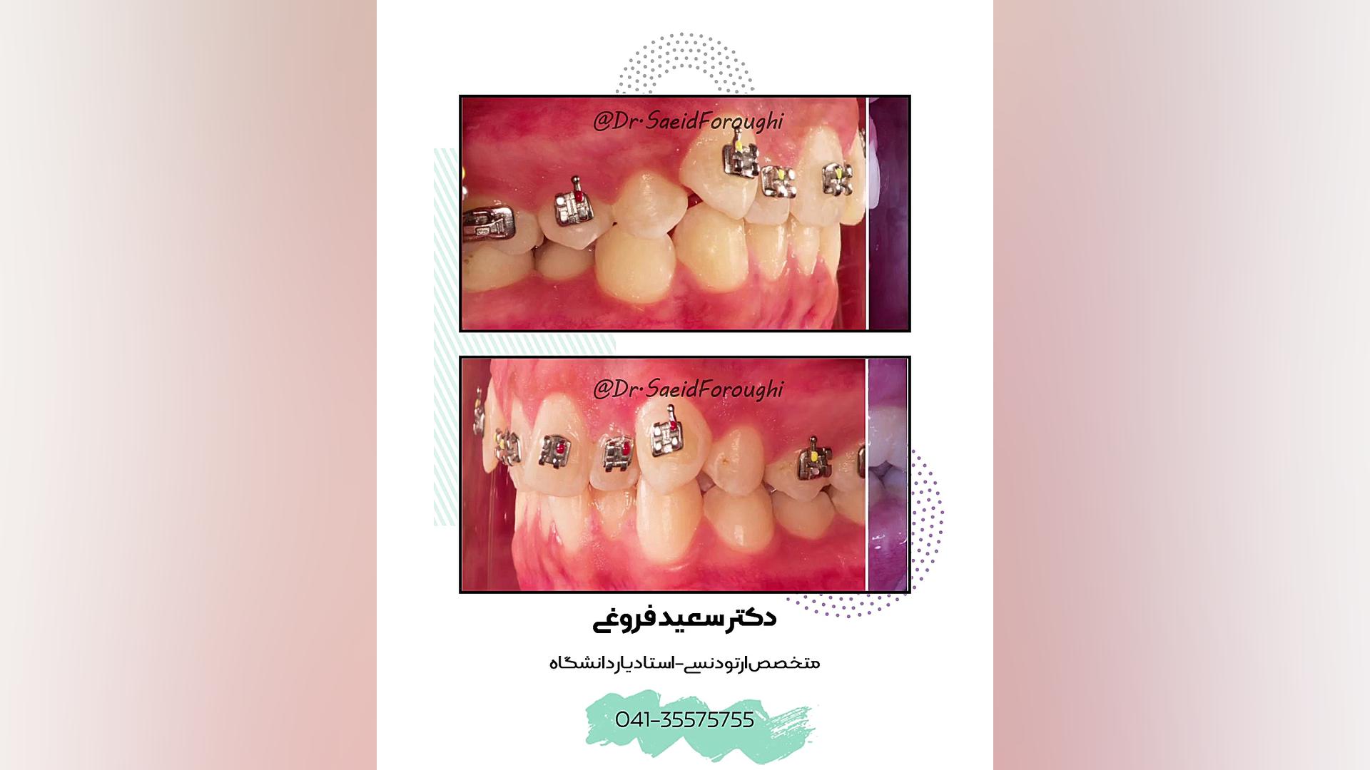 رفع بی نظمی و ناهماهنگی دندانهای فک بالا و پایین توسط ارتودنسی ثابت دکتر سعید فروغی متخصص ارتودنسی