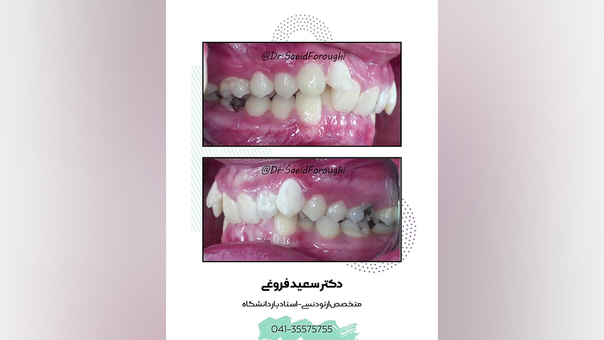 درمان ھمپوشانی بیش از حد دندانھای جلویی و اصلاح شیب دندانھای فک بالا بھ ھمراه رف دکتر سعید فروغی متخصص ارتودنسی