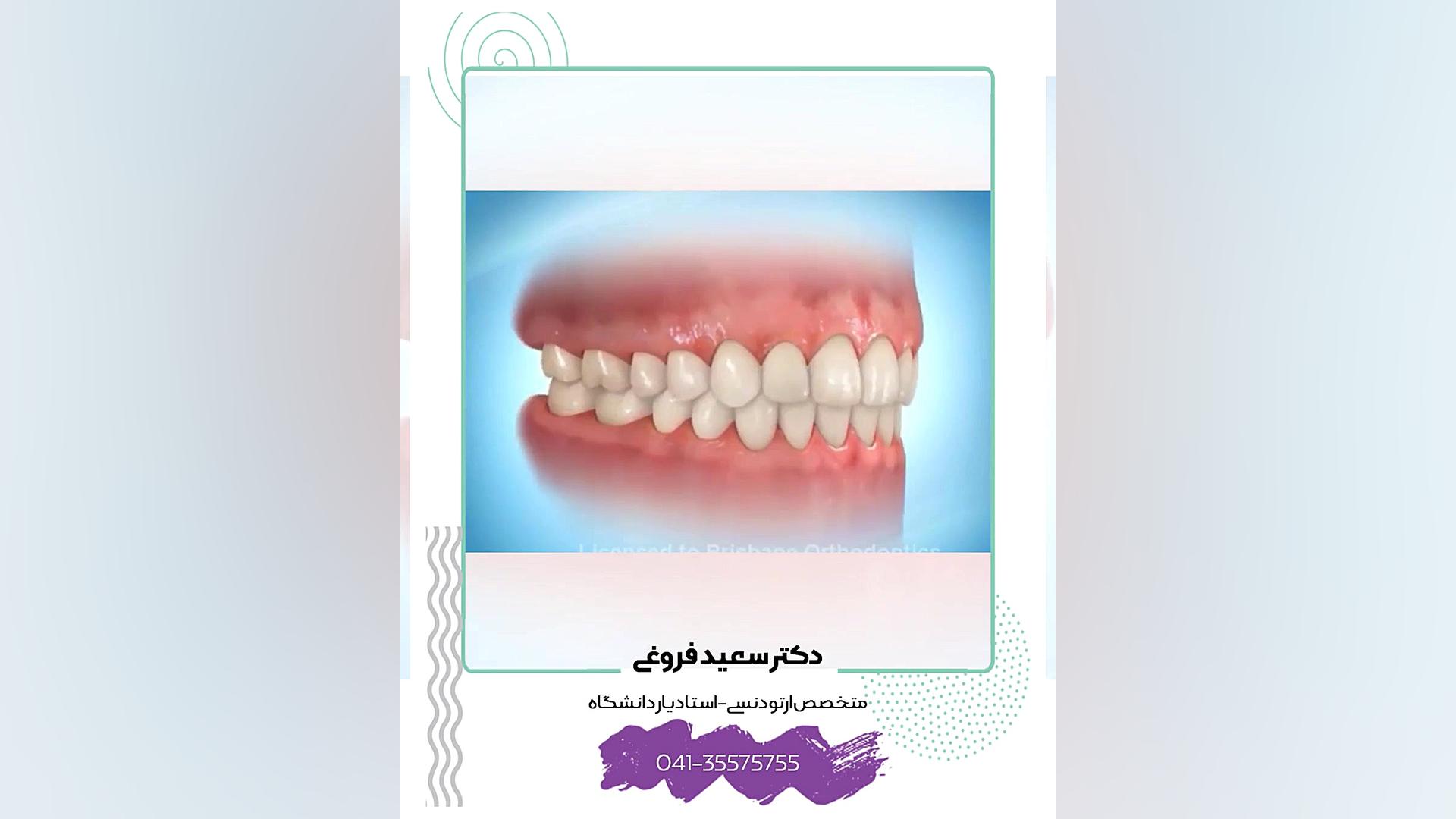 دستگاه های فانکشنال ارتودنسی معمولا دستگاههایی متحرک و قابل گذاشتن و برداشتن توس دکتر سعید فروغی متخصص ارتودنسی