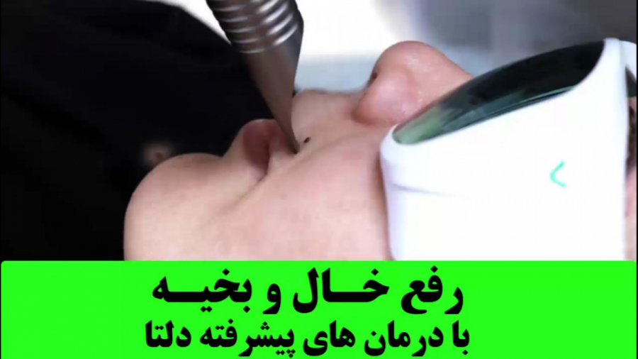 برداشتن خال و جای زخم و بخیه با لیزر هایپرپاراتیروئیدیسم
