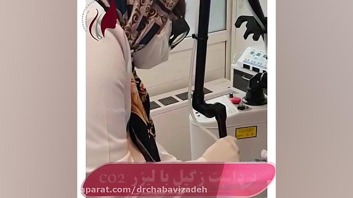 فیلم واقعی برداشتن زگیل با لیزر co2 دکتر صفیه چعباوی زاده