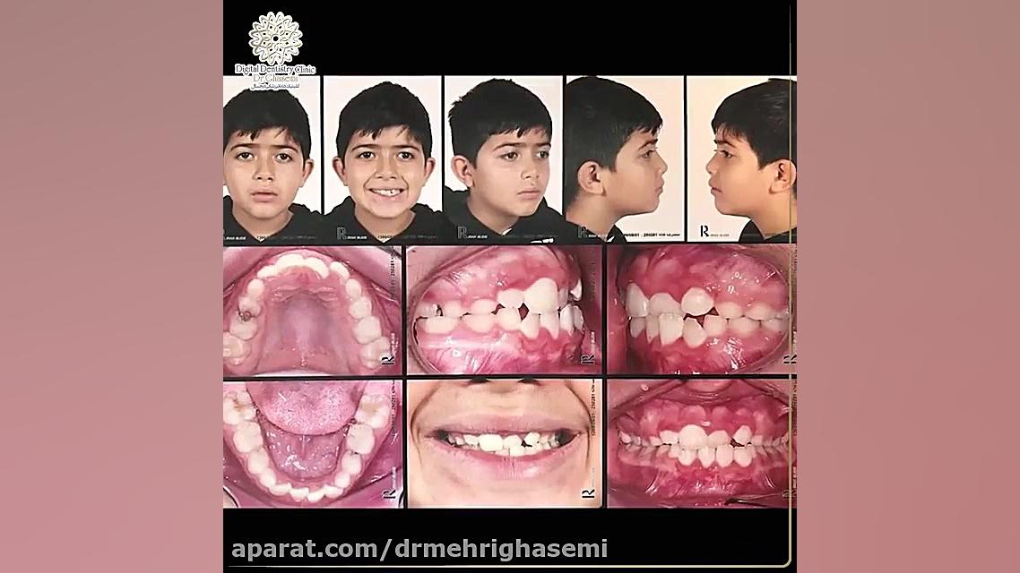 درمان ناهنجاری فکی با استفاده از مولتی پی فرانسه | کلینیک دندانپزشکی دکتر قاسمی مرکز دندانپزشکی دیجیتال دکتر مهری قاسمی