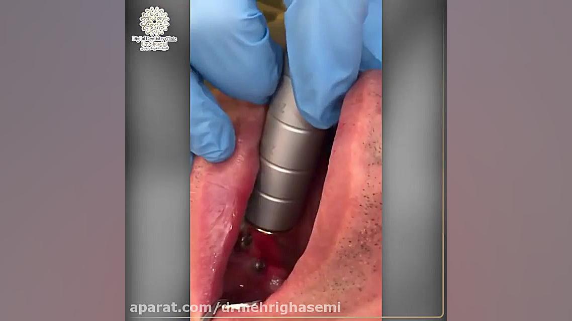 بهبود بافت نرم محل جراحی و درد در محل جراحی ایمپلنت | کلینیک دیجیتال دکتر قاسمی مرکز دندانپزشکی دیجیتال دکتر مهری قاسمی