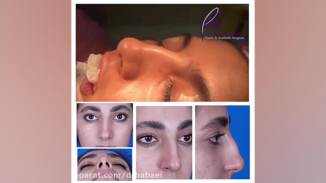 فیلم بلافاصله بعد از عمل بینی دکتر کامران بابایی